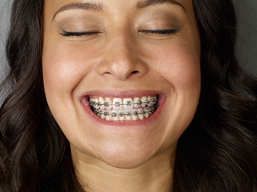 krassen specificatie punch Beugels - Orthodontie Barneveld